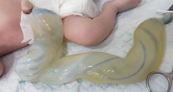une malformation congenitale rare le cordon ombilical geant gynecologie obstetrique pratique
