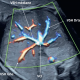 La vascularisation abdominale fœtale et ses anomalies